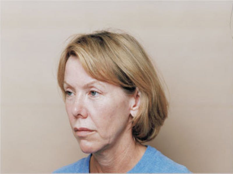 Facelift Before & After Gallery - Patient 380850 - Image 3