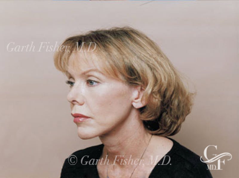 Facelift Before & After Gallery - Patient 380850 - Image 4
