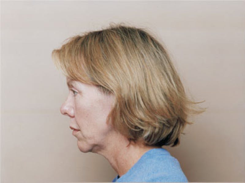 Facelift Before & After Gallery - Patient 380850 - Image 5