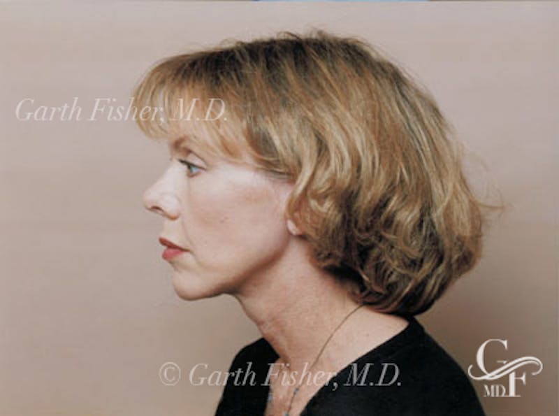 Facelift Before & After Gallery - Patient 380850 - Image 6