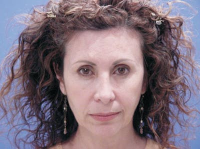 Facelift Before & After Gallery - Patient 239548 - Image 1