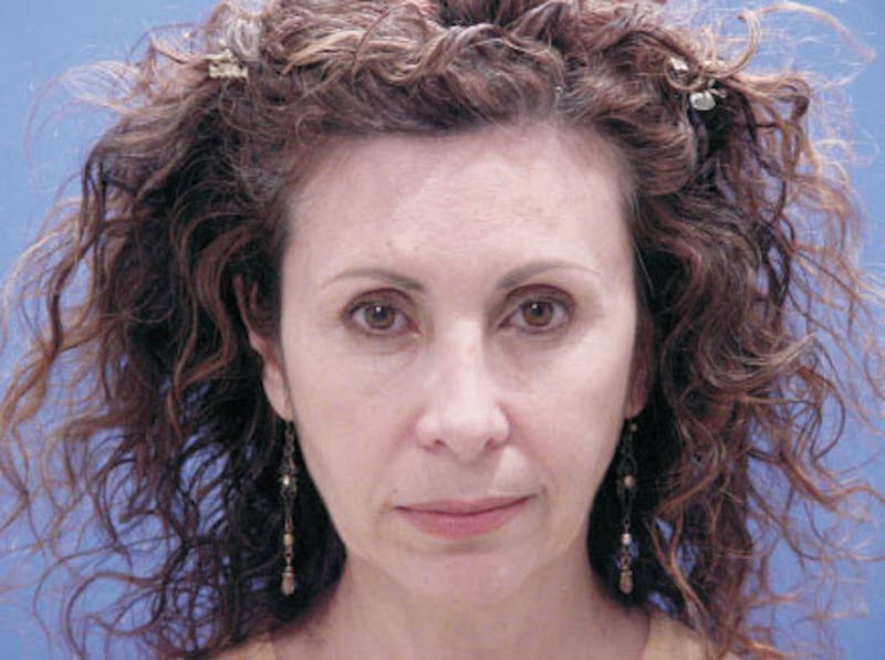 Facelift Before & After Gallery - Patient 239548 - Image 1
