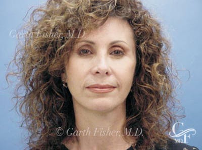 Facelift Before & After Gallery - Patient 239548 - Image 2