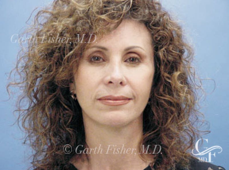 Facelift Before & After Gallery - Patient 239548 - Image 2