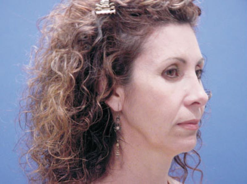 Facelift Before & After Gallery - Patient 239548 - Image 3