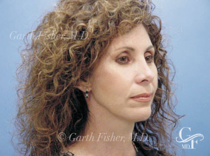 Facelift Before & After Gallery - Patient 239548 - Image 4