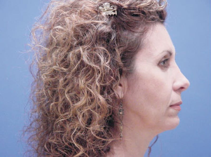 Facelift Before & After Gallery - Patient 239548 - Image 5