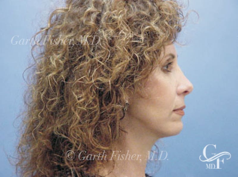 Facelift Before & After Gallery - Patient 239548 - Image 6