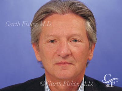 Facelift Before & After Gallery - Patient 378097 - Image 2