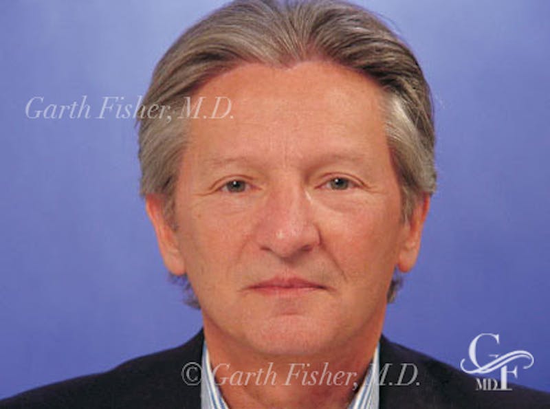 Facelift Before & After Gallery - Patient 378097 - Image 2