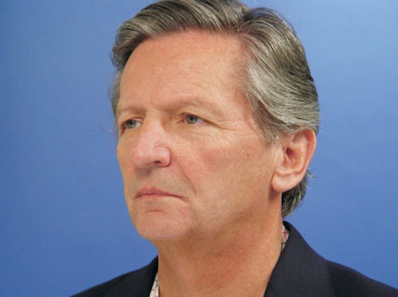Facelift Before & After Gallery - Patient 378097 - Image 3