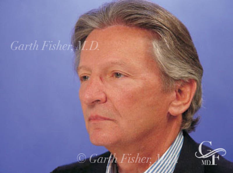 Facelift Before & After Gallery - Patient 378097 - Image 4