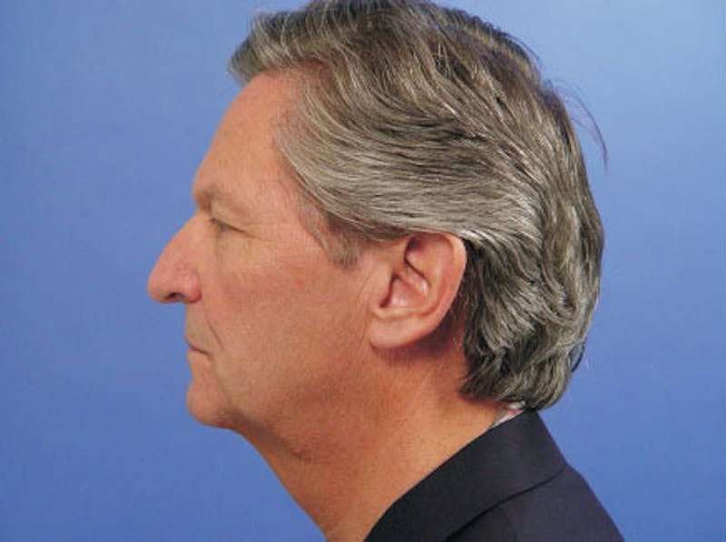 Facelift Before & After Gallery - Patient 378097 - Image 5