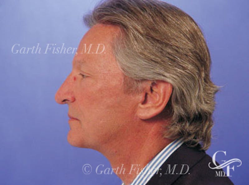 Facelift Before & After Gallery - Patient 378097 - Image 6