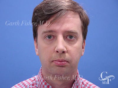 Facelift Before & After Gallery - Patient 557264 - Image 2