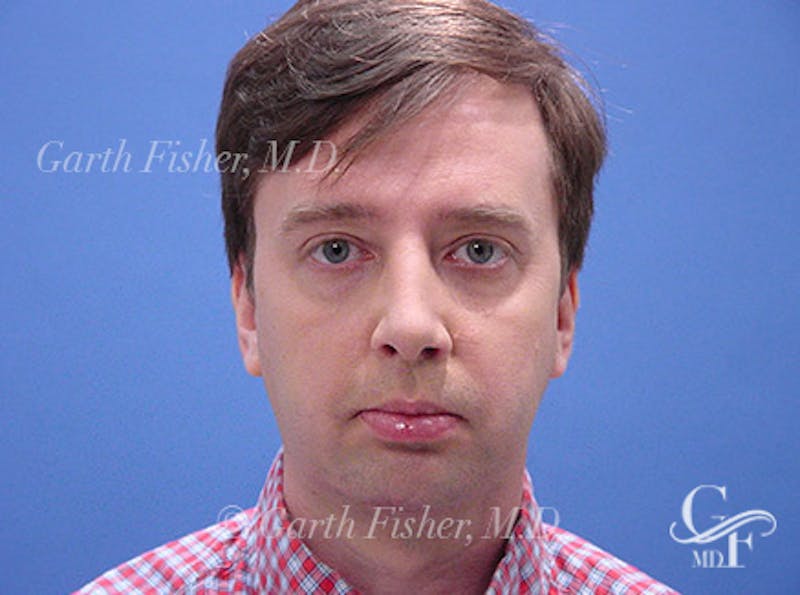 Facelift Before & After Gallery - Patient 557264 - Image 2