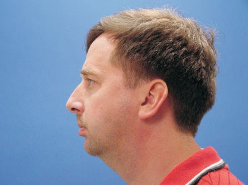 Facelift Before & After Gallery - Patient 557264 - Image 3