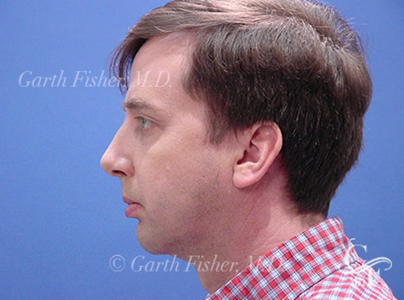 Facelift Before & After Gallery - Patient 557264 - Image 4