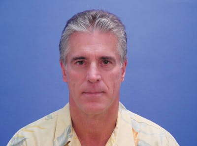 Facelift Before & After Gallery - Patient 305512 - Image 1