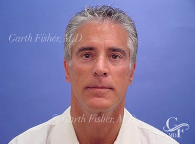 Facelift Before & After Gallery - Patient 305512 - Image 2