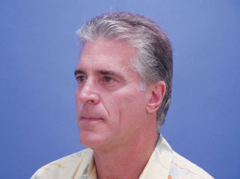 Facelift Before & After Gallery - Patient 305512 - Image 3