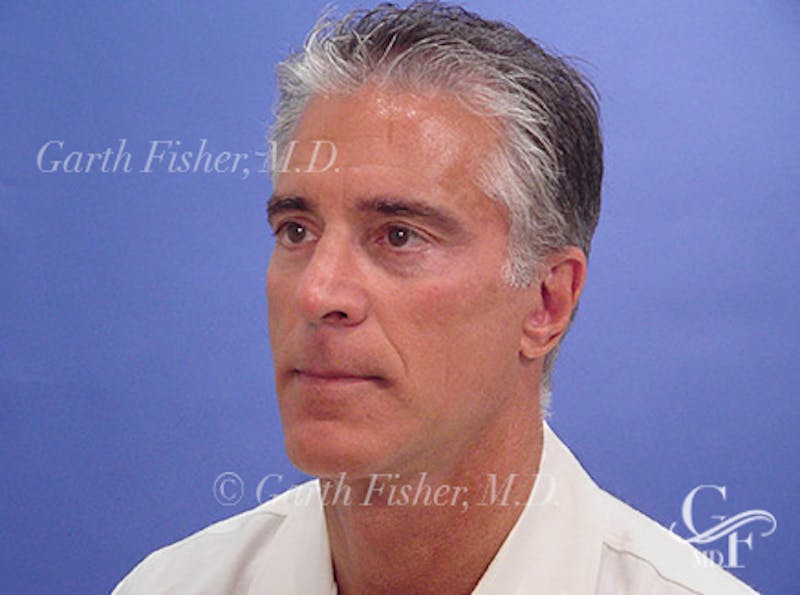 Facelift Before & After Gallery - Patient 305512 - Image 4