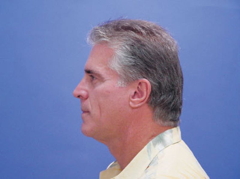 Facelift Before & After Gallery - Patient 305512 - Image 5