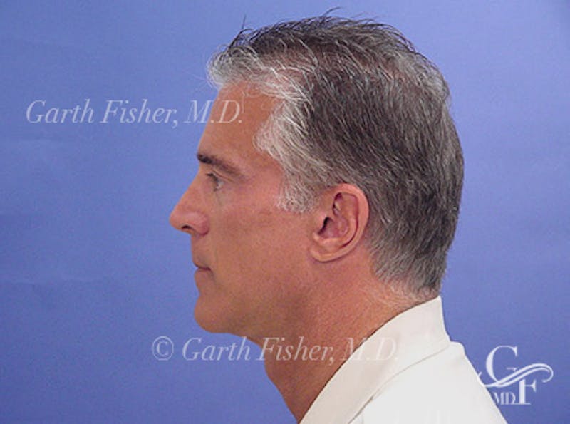 Facelift Before & After Gallery - Patient 305512 - Image 6