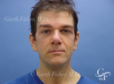Facelift Before & After Gallery - Patient 418821 - Image 2