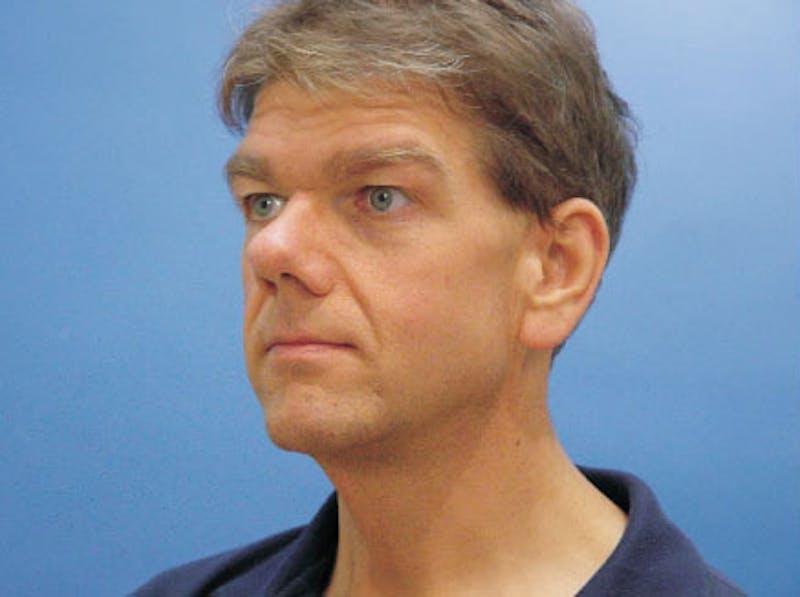 Facelift Before & After Gallery - Patient 418821 - Image 3