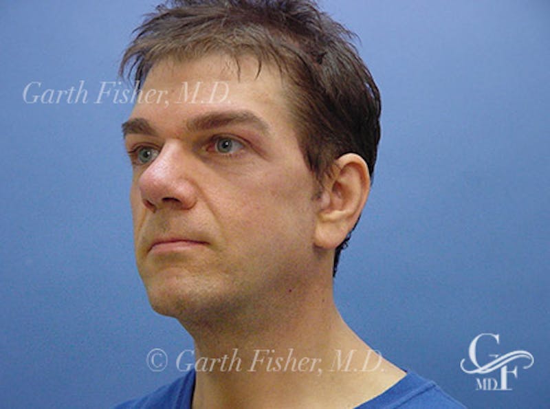 Facelift Before & After Gallery - Patient 418821 - Image 4