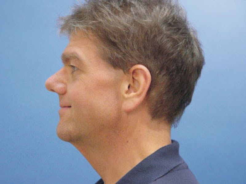 Facelift Before & After Gallery - Patient 418821 - Image 5