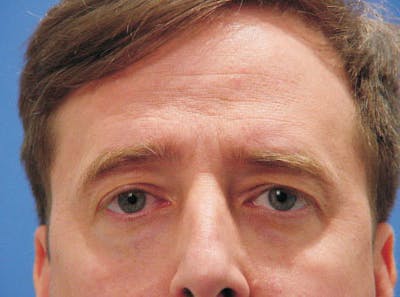 Brow Lift Before & After Gallery - Patient 100021 - Image 1
