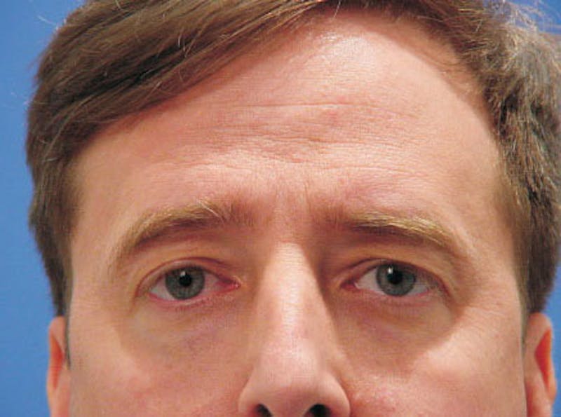 Brow Lift Before & After Gallery - Patient 100021 - Image 1