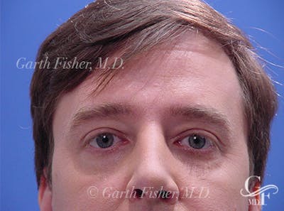 Brow Lift Before & After Gallery - Patient 100021 - Image 2
