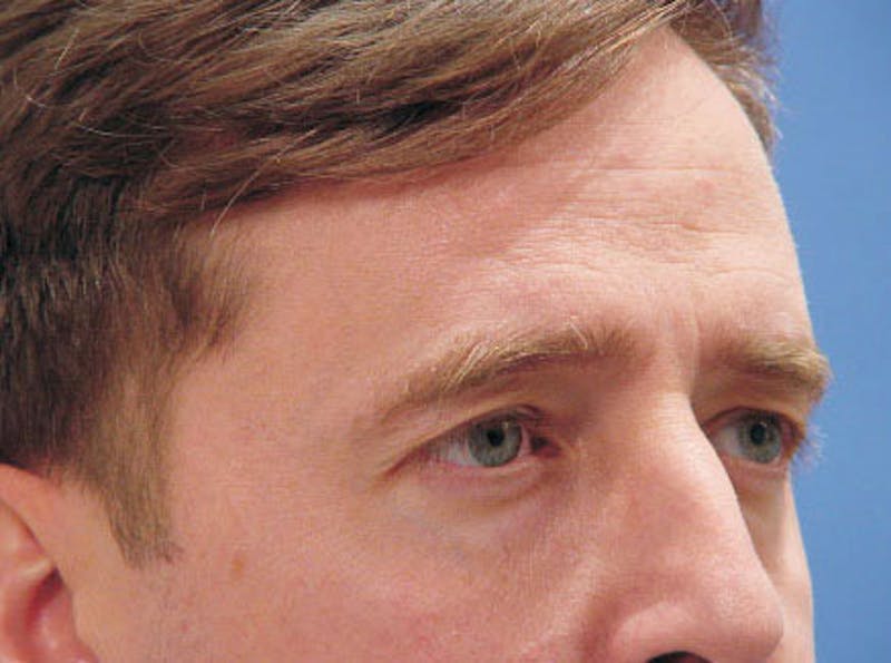 Brow Lift Before & After Gallery - Patient 100021 - Image 3