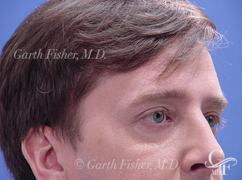 Brow Lift Before & After Gallery - Patient 100021 - Image 4