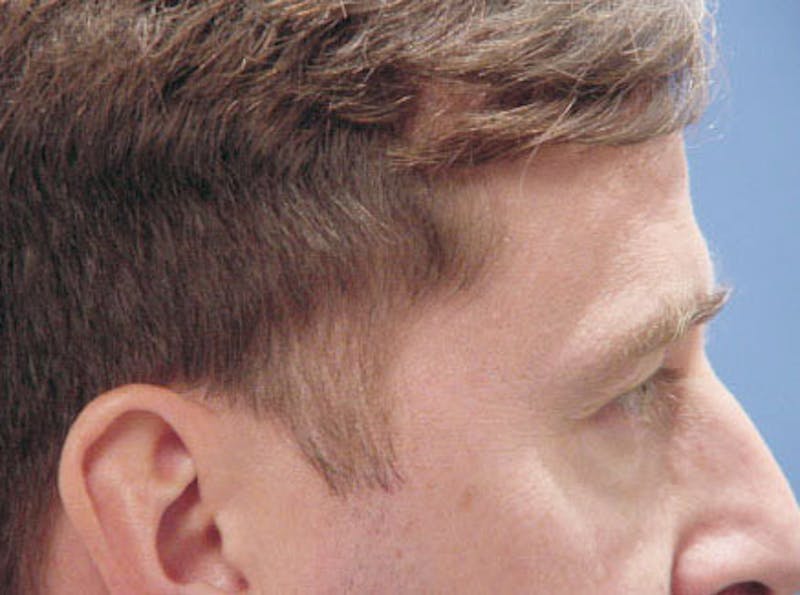 Brow Lift Before & After Gallery - Patient 100021 - Image 5