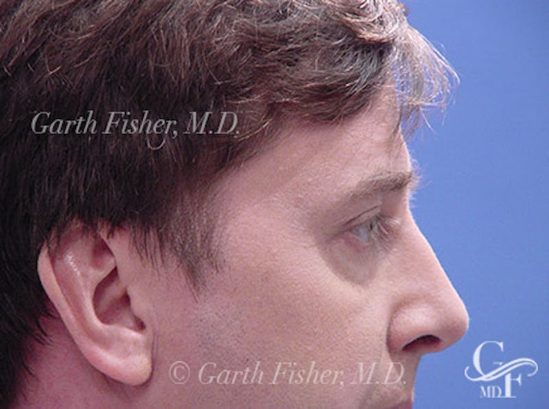 Brow Lift Before & After Gallery - Patient 100021 - Image 6