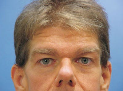 Brow Lift Before & After Gallery - Patient 300966 - Image 1