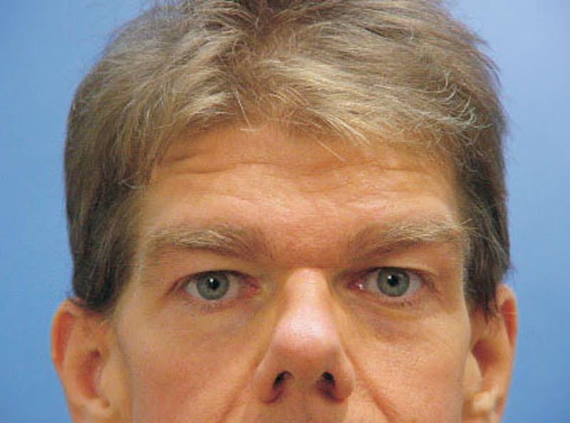 Brow Lift Before & After Gallery - Patient 300966 - Image 1