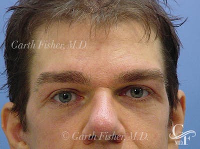 Brow Lift Before & After Gallery - Patient 300966 - Image 2