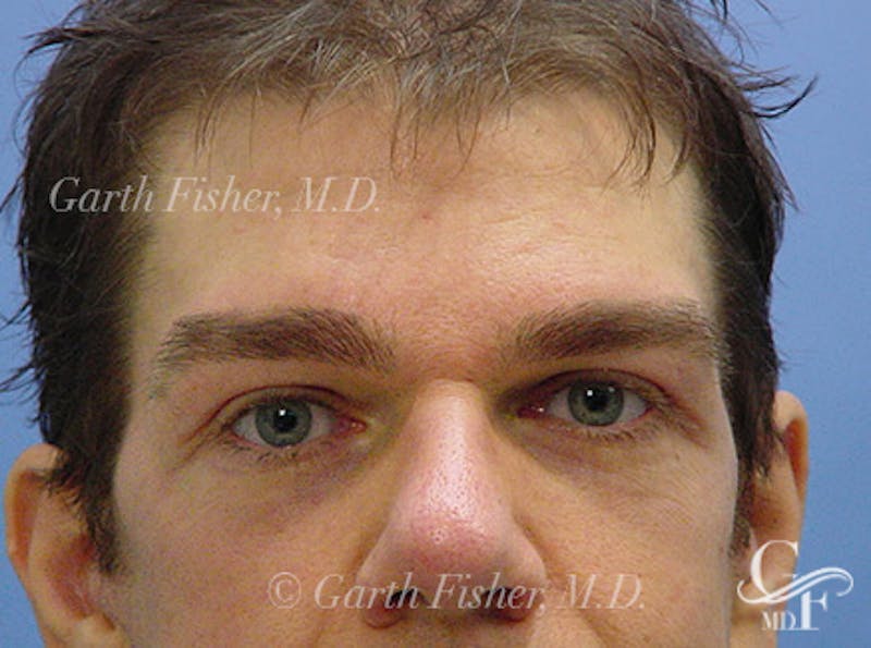 Brow Lift Before & After Gallery - Patient 300966 - Image 2