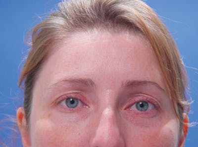 Brow Lift Before & After Gallery - Patient 184803 - Image 1