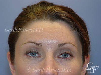 Brow Lift Before & After Gallery - Patient 184803 - Image 2