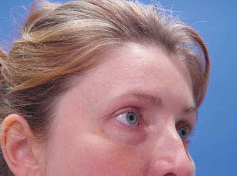 Brow Lift Before & After Gallery - Patient 184803 - Image 3