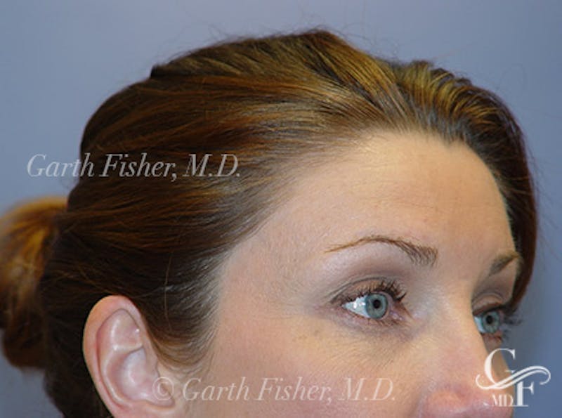 Brow Lift Before & After Gallery - Patient 184803 - Image 4