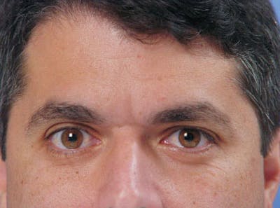 Brow Lift Before & After Gallery - Patient 185599 - Image 1