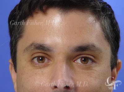 Brow Lift Before & After Gallery - Patient 185599 - Image 2