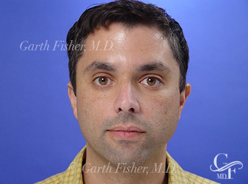Brow Lift Before & After Gallery - Patient 185599 - Image 4